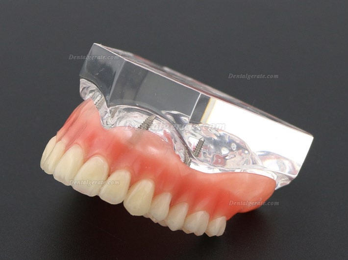 Anatomisches Modell der Zahnz&auml;hne &Uuml;berprothese Superior mit 4 Implantaten Demo Modell 6001